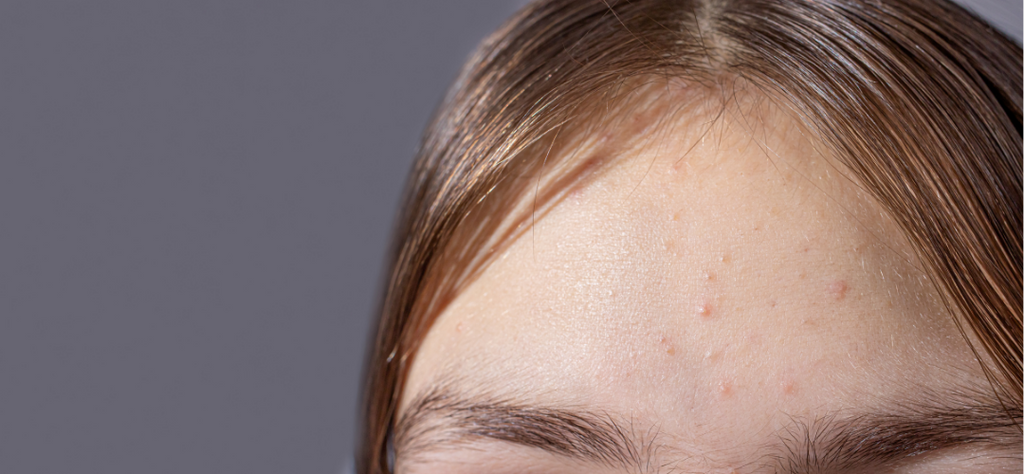 Adult Acne: The Causes and Preventatives